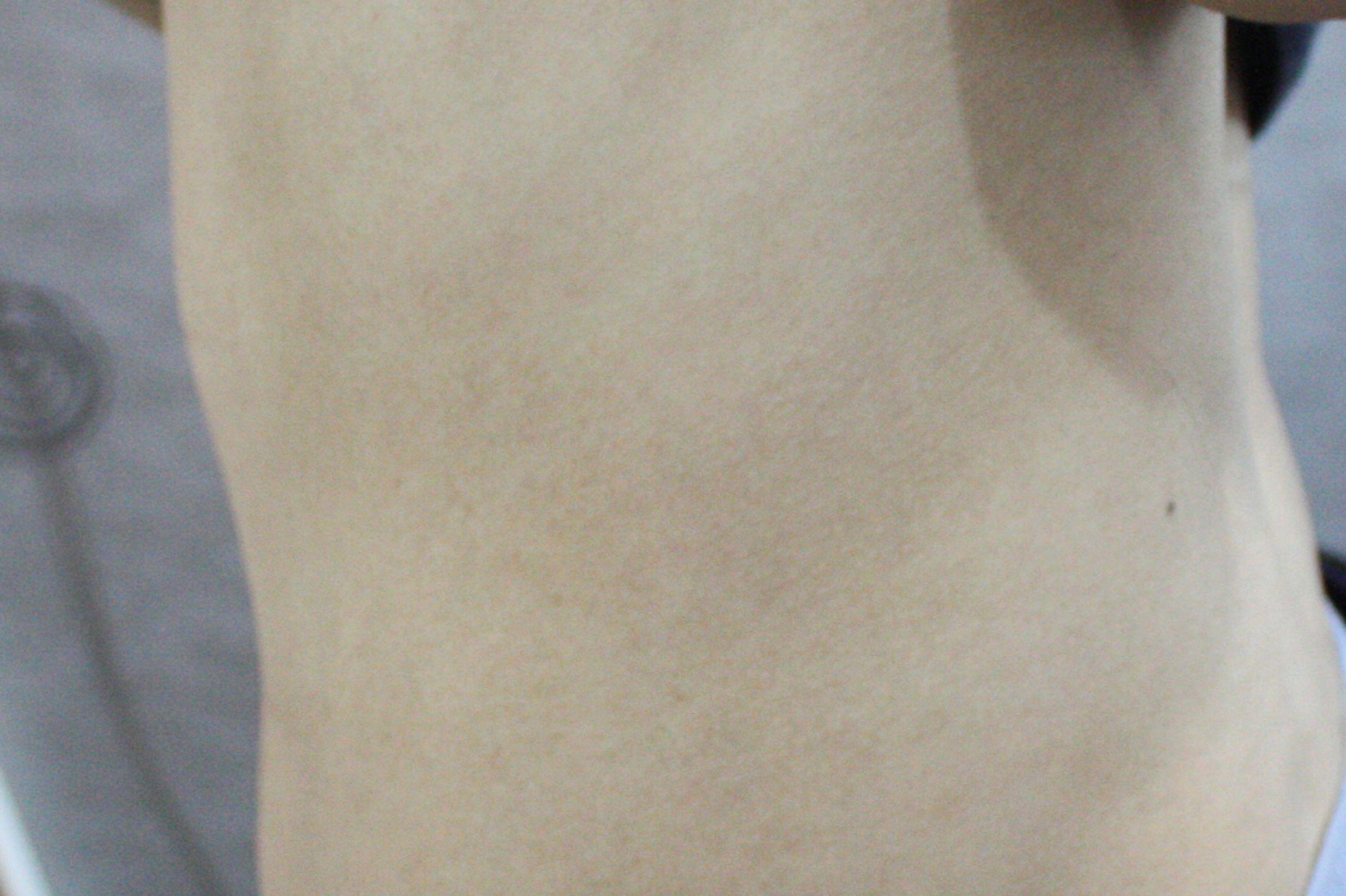 습진 치료 후