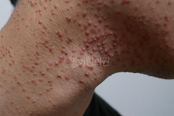 모낭염 치료 전