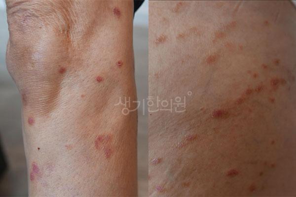 건선 치료 전