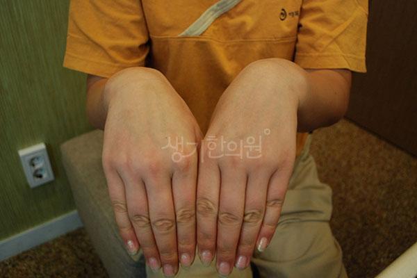 건선 치료 후